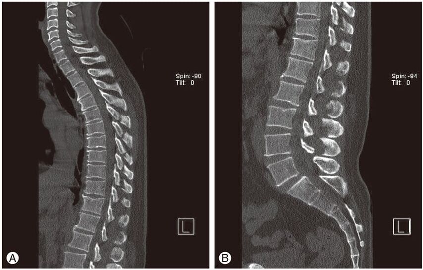 Verformung der Bandscheiben in der Magnetresonanztomographie bei thorakaler Osteochondrose