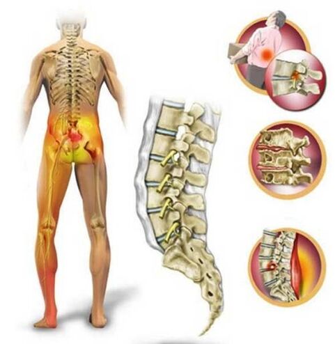 Osteochondrose der Lendenwirbelsäule, die Rückenschmerzen verursacht. 