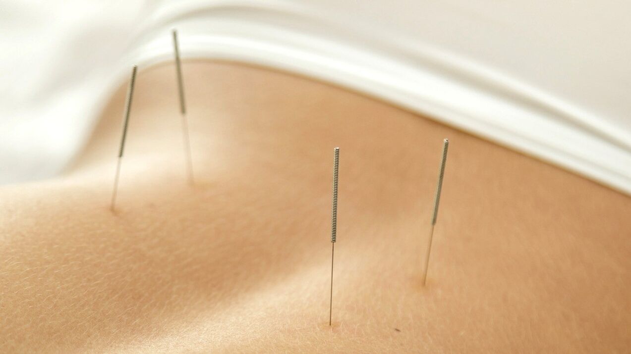 Akupunktur hilft, Schmerzen im unteren Rückenbereich zu beseitigen